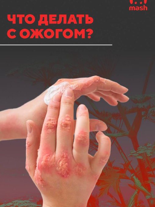 Осторожно, борщевик! Растение может вызвать серьезные ожоги на коже